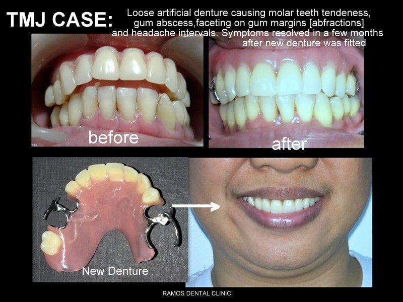 TMJ Case Due To Loose Artificial Denture