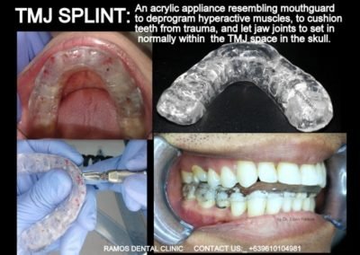 TMJ Splint & Healing Effects