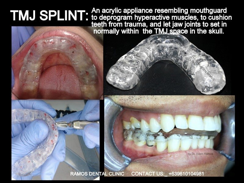 TMJ Splint & Healing Effects