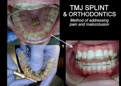 TMJ Splint & Orthodontic Splint