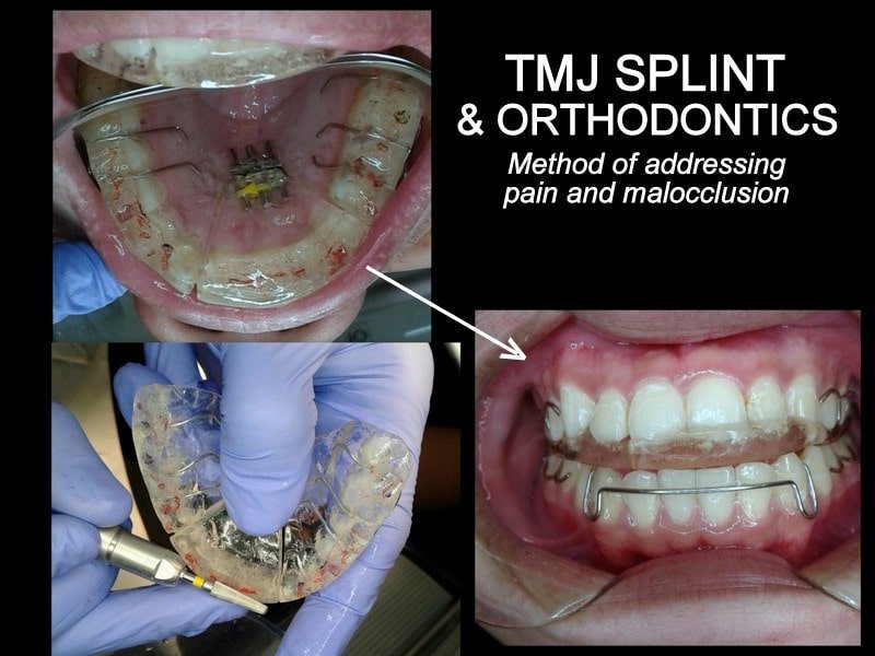tmj splint dental orthodontic pain mouth treatment bite help don management