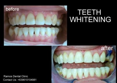 Teeth Whitening