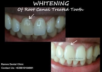 Whitening Root Canal Treated Central Incisor