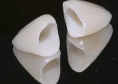 Zirconia Crown