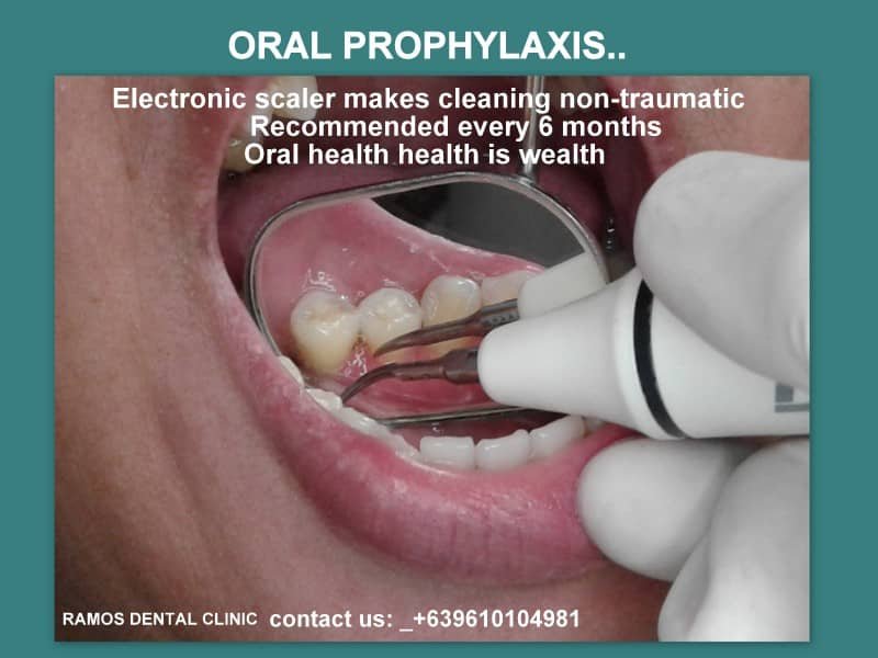 Oral Prophylaxis Through Electronic Scaler