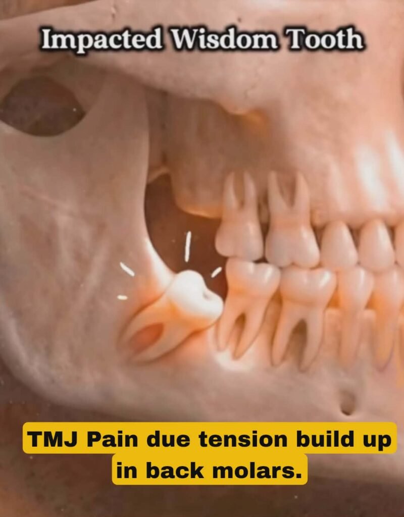 Wisdom Tooth